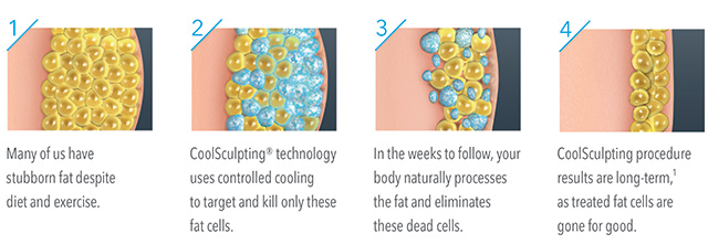 coolsculpting